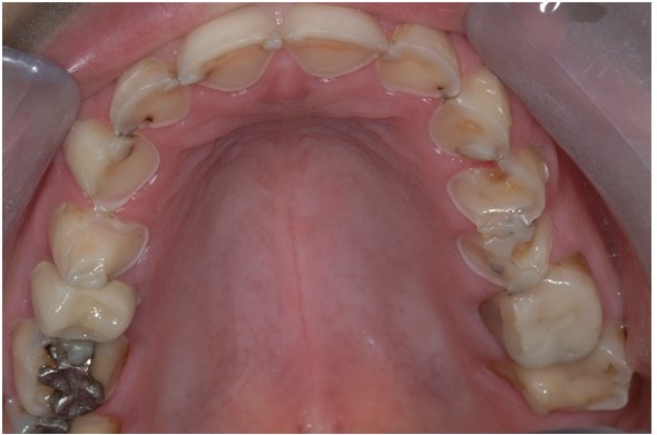 Pesquisa da USP desenvolve gel contra erosão dentária 