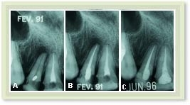 Tratamento de Canal - Endodontia