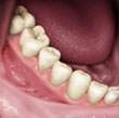 O que são implantes dentários?