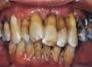 Doença periodontal pode levar à perda dos dentes