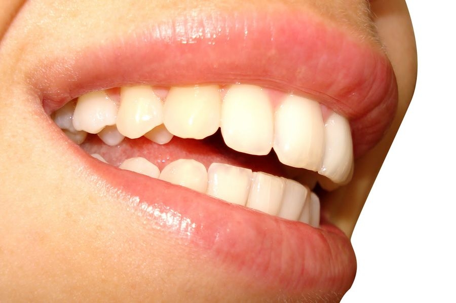 Clareamento dental sem orientação pode trazer riscos