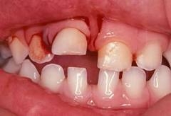 Aprenda o que fazer nos traumas dentários em crianças 