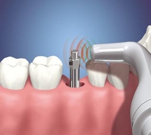 O que o implante dentário tem em comum com a musculação?