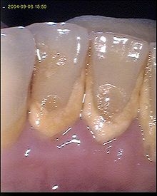 Saiba como prevenir placas bacterianas nos dentes 