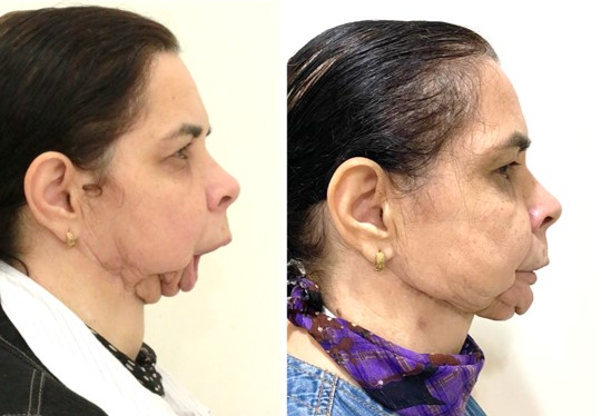 RECONSTRUÇÃO MANDIBULAR REALIZADA COM AUXÍLIO DE TECNOLOGIA DE IMPRESSÃO 3D