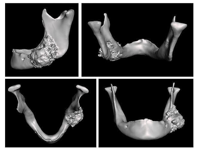 Reconstrução de Mandíbula com auxílio de tecnologia 3d