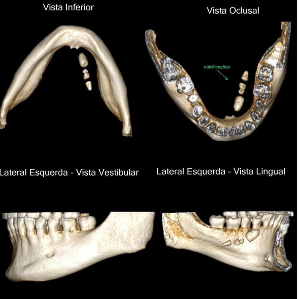 Cirurgia para remoção de Sialolitos (pedras de calcificações)