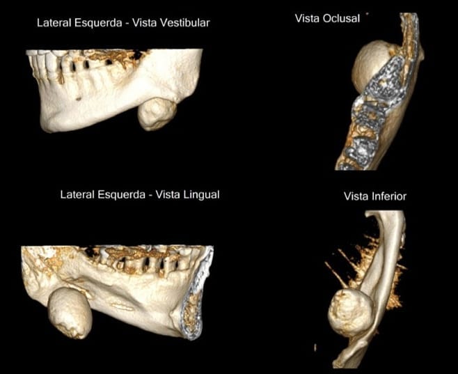 Cirurgia para Remoção de Sialolito de Glândula Submandibular