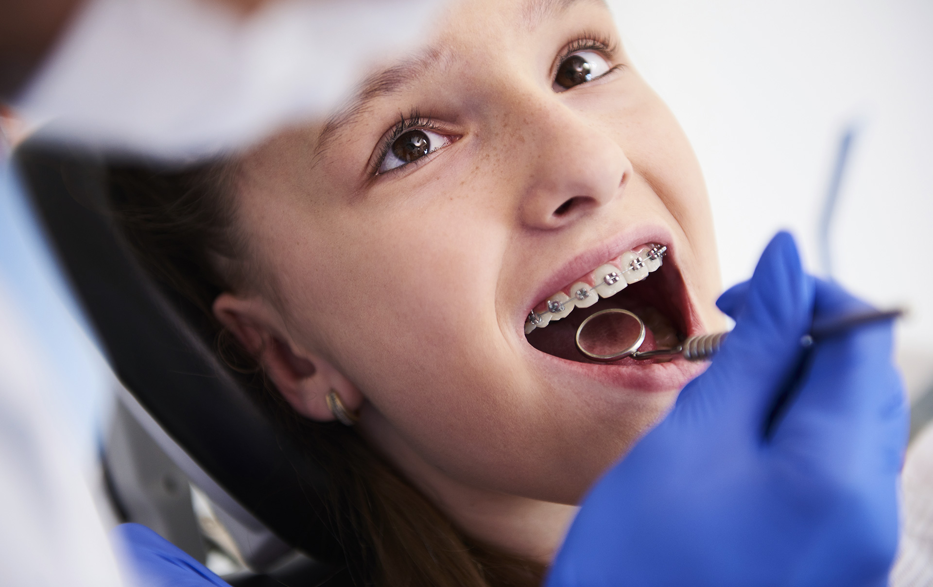 Antes e depois dos aparelhos ortodônticos: o que esperar quando o tirar?