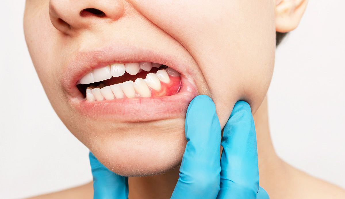 Gengiva crescendo por cima do dente:  o que pode ser?