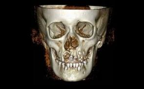 Novo enxerto ósseo sintético recruta células-tronco para promover cicatrização