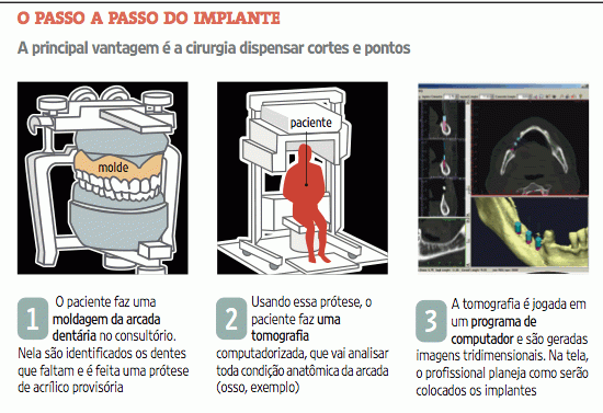 Nova técnica coloca implante dentário sem corte na boca 