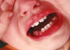 Dentes de leite servirão no tratamento com células-tronco 