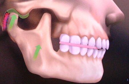 Ranger os dentes pode estar associado à doença respiratória