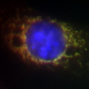 Inibição de proteína pode levar a nova terapia contra câncer de cabeça e pescoço