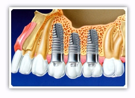 Implantes dentários curtos são alternativa à enxertos ósseos