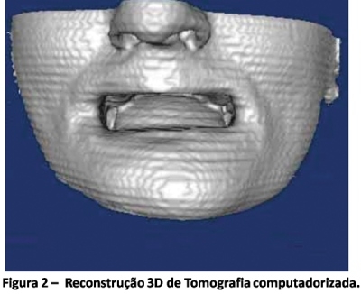 A reconstrução em 3D nas cirúrgias bucais