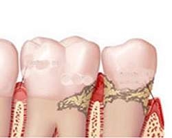 Problemas nas gengivas aumentam níveis de colesterol ruim