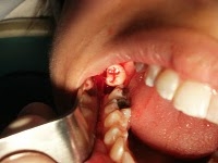 Cirúrgia do siso exige dieta recomendada