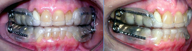 Distúrbios do sono pode ser causado por problemas odontológicos
