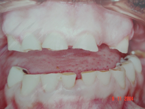 Estresse pode causar uma disfunção oral – bruxismo