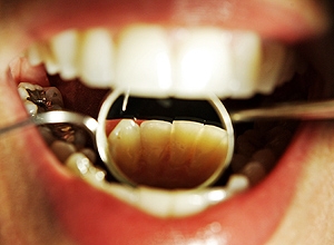 Laser usado para prevenir cárie promete um sorriso mais saudável