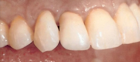 Solução para repor os dentes sem enxerto ósseo