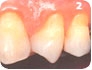 Dentes sensiveis:saibas suas causas e o seu tratamento