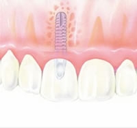 Hipertensos e diabéticos podem fazer implantes dentários?