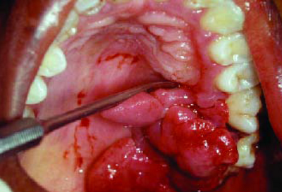 Lesões bucais em grávidas: a prevenção é o melhor remédio