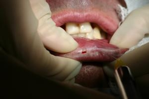 Seriedade do câncer de boca é subestimada