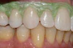 Alimentos e bebidas mancham os dentes em longo prazo.