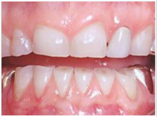 Bruxismo: alívio da dor está na cadeira do cirurgião-dentista