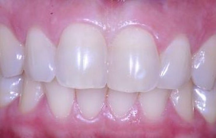 Clareamento Dental: Riscos e Benefícios