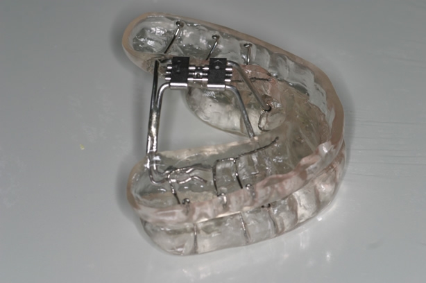 Ronco e apnéia do sono, aparelho oral é uma nova opção de tratamento.