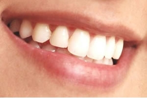 Mulheres em tratamento da osteoporose devem redobrar os cuidados bucais