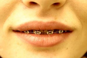 O fim do sorriso metálico