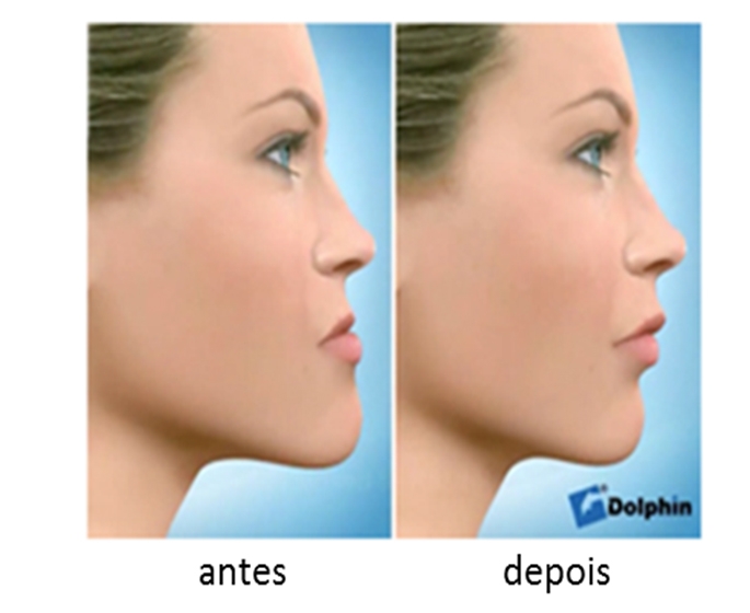 Cirurgia Ortognática: O tratamento que corrige as deformidades ósseas da face.