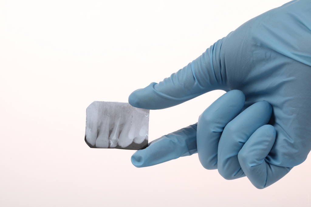 Radiografia da boca pode identificar sinais de osteoporose