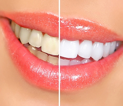 Café, refrigerante, bebidas alcoólicas e cigarro podem escurecer os dentes