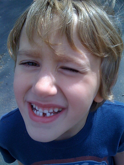 O que fazer quando o dente do seu filho quebra ou cai