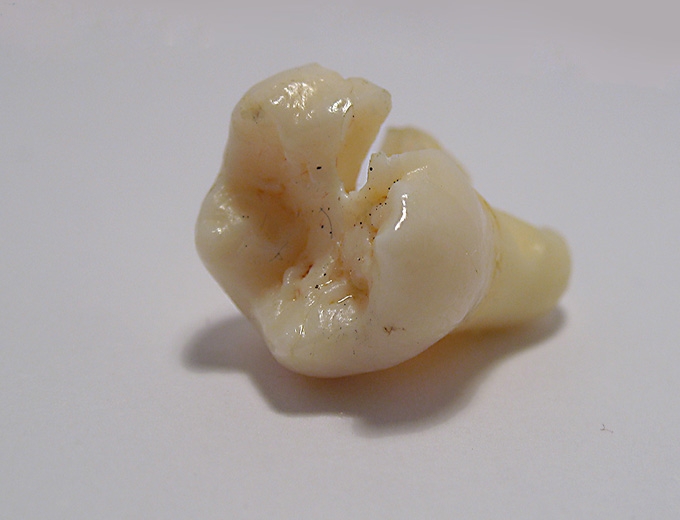 Dente do siso quebrado: efeitos adversos caso deixe sem tratar